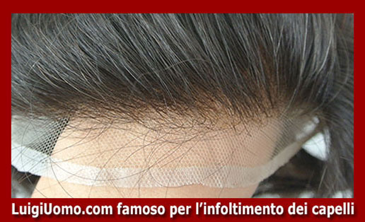 Trapianti capelli impianti capillari infoltimento capelli uomo donna San Cesareo Artena Fiano Romano Lanuvio Lariano di modello 1