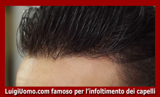 Trapianti capelli impianti capillari infoltimento capelli uomo donna San Cesareo Artena Fiano Romano Lanuvio Lariano di modello 10