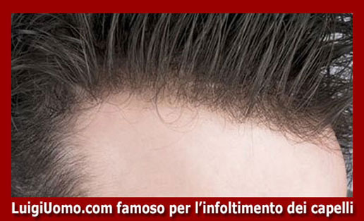 Trapianti capelli impianti capillari infoltimento capelli uomo donna Tiburtino Prenestino Labicano Tuscolano Appio Latino di modello 2