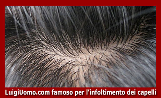 Trapianti capelli impianti capillari infoltimento capelli uomo donna San Cesareo Artena Fiano Romano Lanuvio Lariano di modello 3