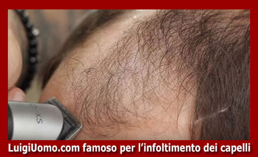 Trapianti capelli impianti capillari infoltimento capelli uomo donna Ariccia Santa Marinella Zagarolo Rocca di Papa Valmontone di modello 7