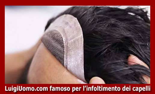 Trapianti capelli impianti capillari infoltimento capelli uomo donna Guidonia Montecelio Fiumicino Pomezia Tivoli di modello 8