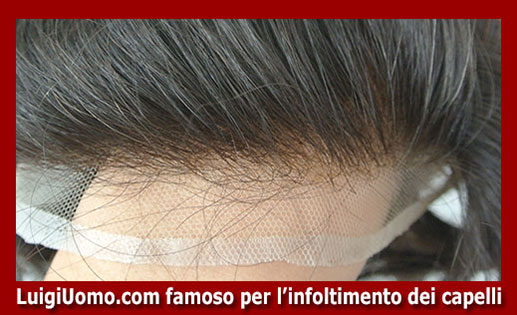 Trapianti di capelli fue uomo donna autotrapianto Genova Imperia La Spezia Savona di modello 1