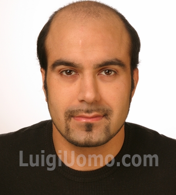 Protesi-capelli-a-San Giovanni Teatino-per-uomo-donna-infoltimento-capelli-impianti-capillari-patch-cutanea-membrana-capillare-1