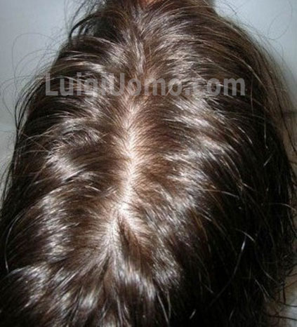 11-infoltimento-capelli-a-Mezzolombardo-per-uomo-donna-non-chirurgico-