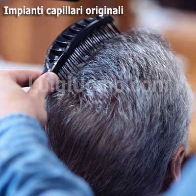 11-trapianti-trapianto-capelli-Brindisi-impianto-impianti-fue-capillare-per-uomo-donna-originali,