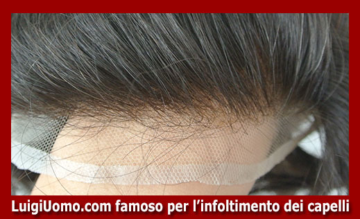 infoltimento dei capelli