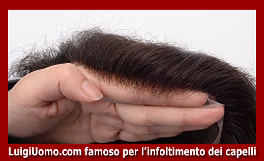 infoltimento capelli donne non chirurgico