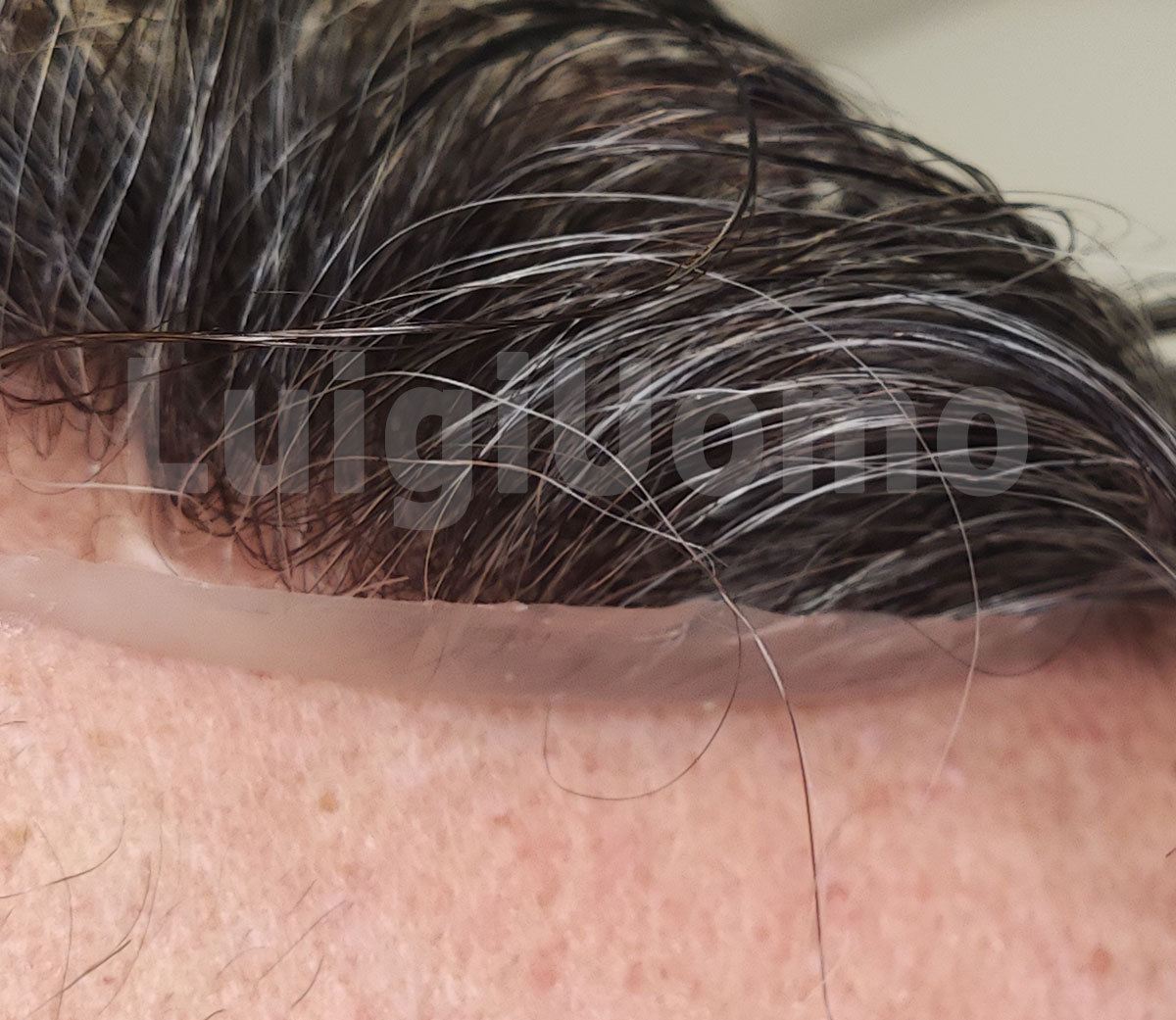 protesi capelli