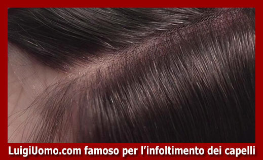 102-protesi-capelli-a-Santo Stefano di Magra-per-uomo-donna-infoltimento-capelli-impianti-capillari-patch-cutanea-membrana-capillare-