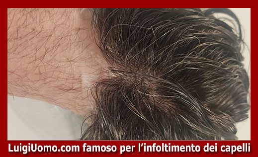 11-protesi-capelli-lace-a-San Giorgio a Cremano-per-uomo-donna-infoltimento-capelli-impianti-capillari-patch-cutanea-membrana-capillare-