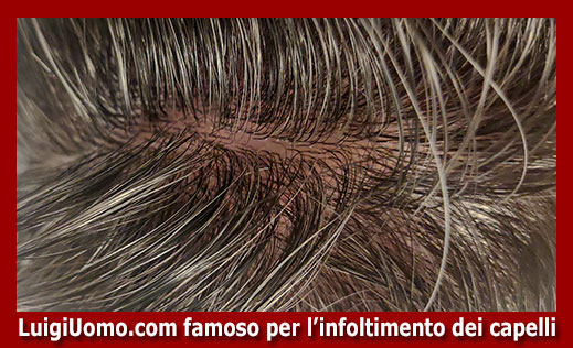 12-Protesi-capelli-a-Reggio Emilia-per-uomo-donna-infoltimento-capelli-impianti-capillari-patch-cutanea-membrana-capillare-