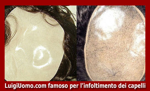 15-protesi-capelli-lace-a-Spinea-per-uomo-donna-infoltimento-capelli-impianti-capillari-patch-cutanea-membrana-capillare-