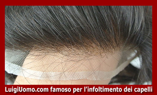 protesi per capelli a Legnano - modello 2 - protesi-per-capelli-Legnano