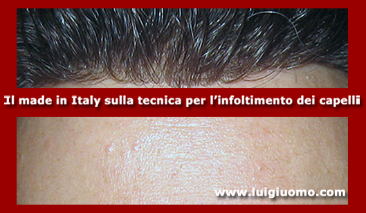 Impianti capelli Impianti tricologici Protesi tricologiche uomo donna Latina di modello 11