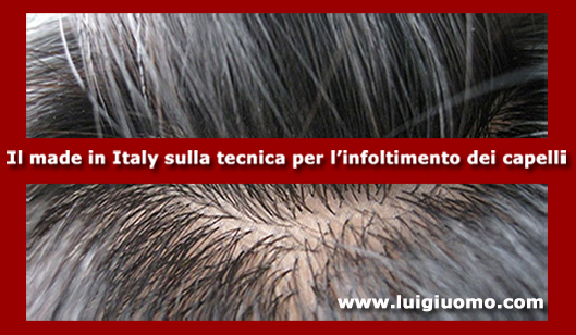 Impianti capelli Impianti tricologici Protesi tricologiche uomo donna Latina di modello 2