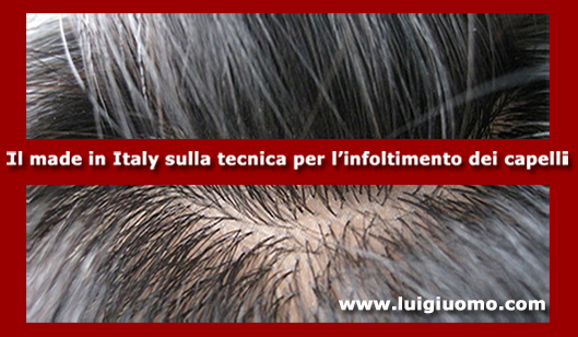 Impianti capelli Impianti tricologici Protesi tricologiche uomo donna Monterotondo Marino Albano Laziale Ladispoli Ciampino di modello 2