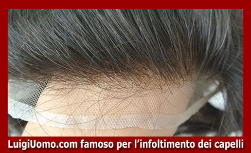 Trapianti capelli impianti capillari infoltimento capelli uomo donna Settecamini Tor Cervara Tor Sapienza Acqua Vergine Lunghezza di modello 1