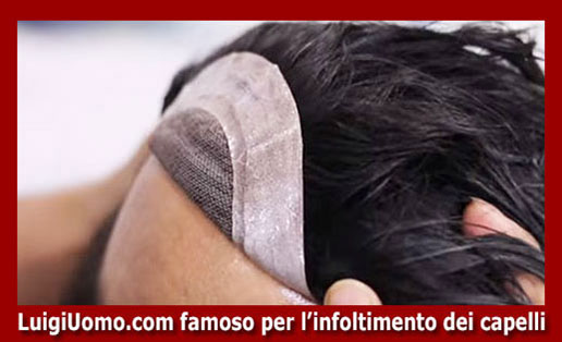 Trapianti capelli impianti capillari infoltimento capelli uomo donna Settecamini Tor Cervara Tor Sapienza Acqua Vergine Lunghezza di modello 8