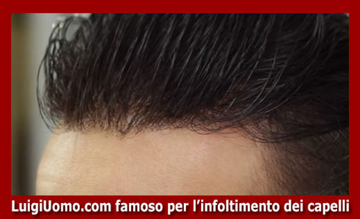 Trapianti di capelli fue uomo donna autotrapianto Massa Carrara Pisa Pistoia Prato Siena di modello 10