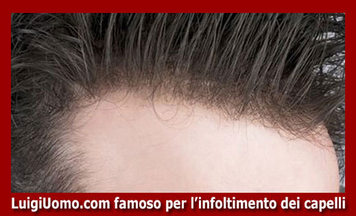 Trapianti di capelli fue uomo donna autotrapianto Massa Carrara Pisa Pistoia Prato Siena di modello 2