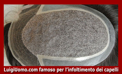 Trapianti di capelli fue uomo donna autotrapianto Massa Carrara Pisa Pistoia Prato Siena di modello 4