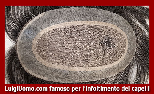Trapianti di capelli fue uomo donna autotrapianto Massa Carrara Pisa Pistoia Prato Siena di modello 5