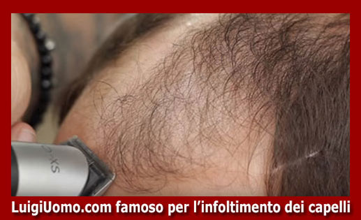 Trapianti di capelli fue uomo donna autotrapianto Massa Carrara Pisa Pistoia Prato Siena di modello 7