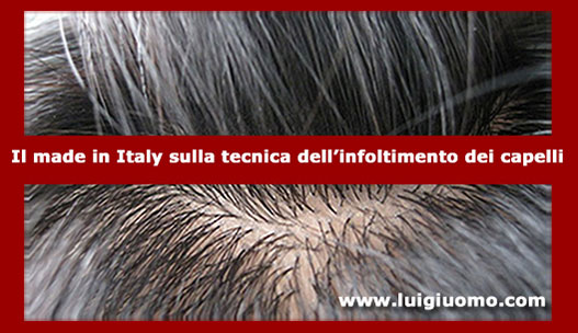 Diradamento capelli uomo donna dermatologo specialista cause Liguria Genova Imperia La Spezia Savona di modello 4