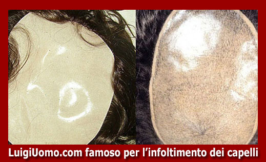 15-infoltimento-capelli-a-Milano-per-uomo-donna-non-chirurgico-