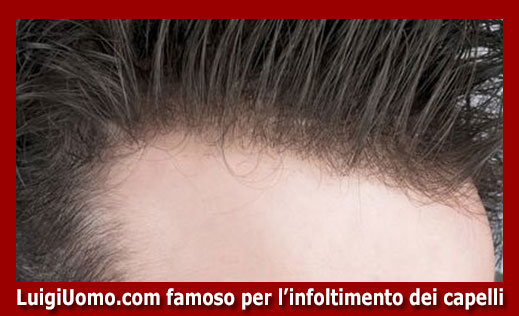 3-parrucche-parrucchino-toupee-toupet-per-uomo-e-donna-a-Genova,