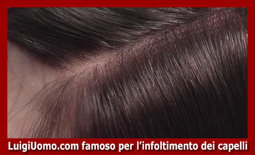 102-protesi-capelli-a-Reggio Emilia-per-uomo-donna-infoltimento-capelli-impianti-capillari-patch-cutanea-membrana-capillare-