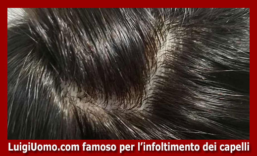 8-Protesi-capelli-a-Reggio Emilia-per-uomo-donna-infoltimento-capelli-impianti-capillari-patch-cutanea-membrana-capillare-